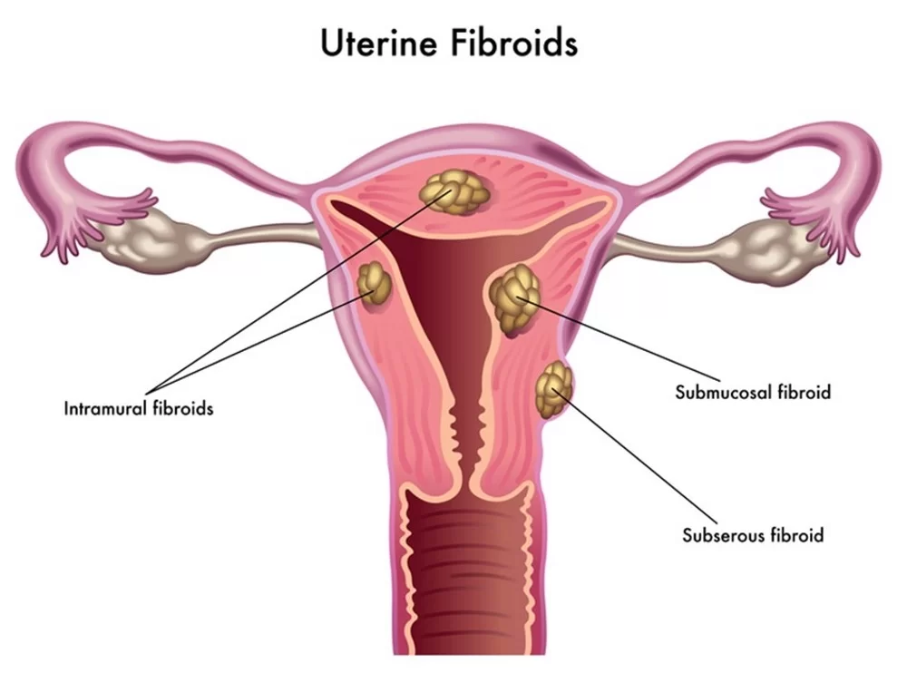 The Great Debate: Navigating the World of Uterine Fibroid and Adenomyosis Treatments