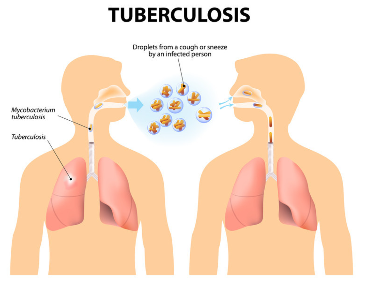 Tuberculosis: The Ancient Foe Still Among Us – What You Need to Know